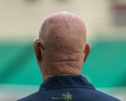 Hair Loss
